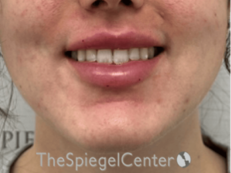 Lip Filler Before & After Gallery - Patient 337305 - Image 2
