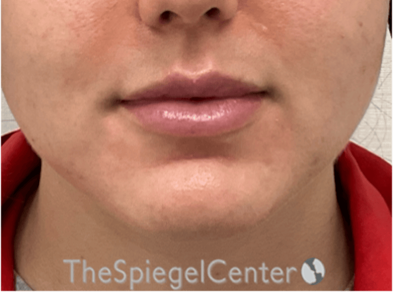 Lip Filler Before & After Gallery - Patient 337305 - Image 3