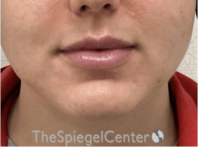 Lip Filler Before & After Gallery - Patient 337305 - Image 3