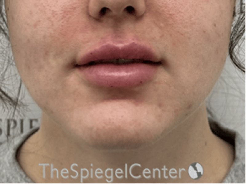 Lip Filler Before & After Gallery - Patient 337305 - Image 4