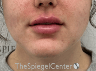 Lip Filler Before & After Gallery - Patient 337305 - Image 4