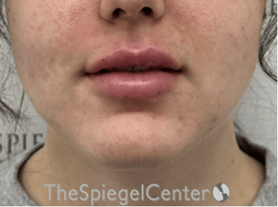 Lip Filler Before & After Gallery - Patient 337305 - Image 4