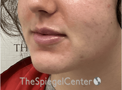 Lip Filler Before & After Gallery - Patient 337305 - Image 5