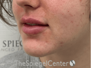 Lip Filler Before & After Gallery - Patient 337305 - Image 6