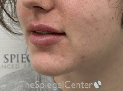 Lip Filler Before & After Gallery - Patient 337305 - Image 6