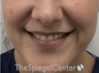Lip Filler Before & After Gallery - Patient 618605 - Image 1
