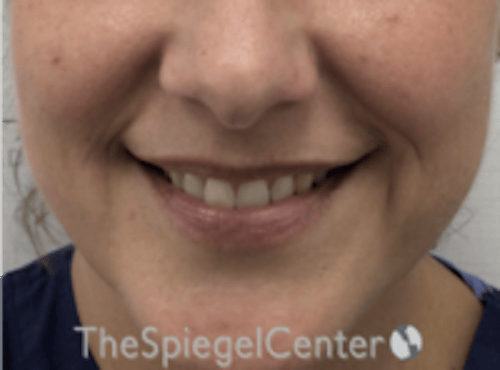 Lip Filler Before & After Gallery - Patient 618605 - Image 1