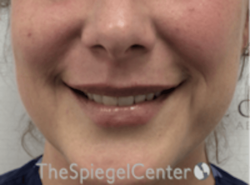 Lip Filler Before & After Gallery - Patient 618605 - Image 2