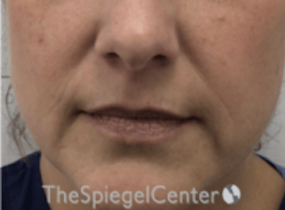 Lip Filler Before & After Gallery - Patient 618605 - Image 3