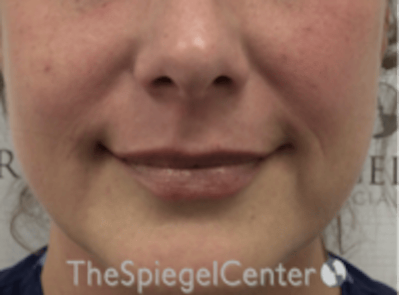 Lip Filler Before & After Gallery - Patient 618605 - Image 4