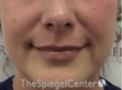 Lip Filler Before & After Gallery - Patient 618605 - Image 4