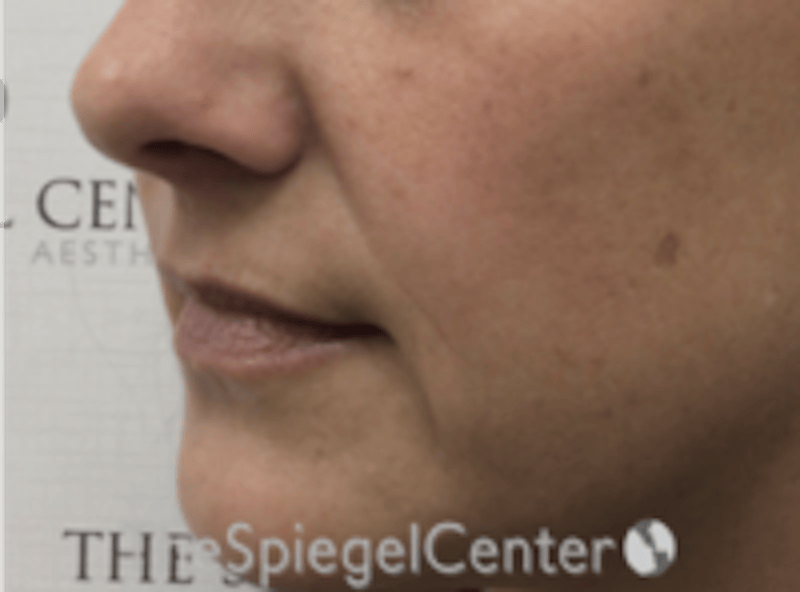 Lip Filler Before & After Gallery - Patient 618605 - Image 5