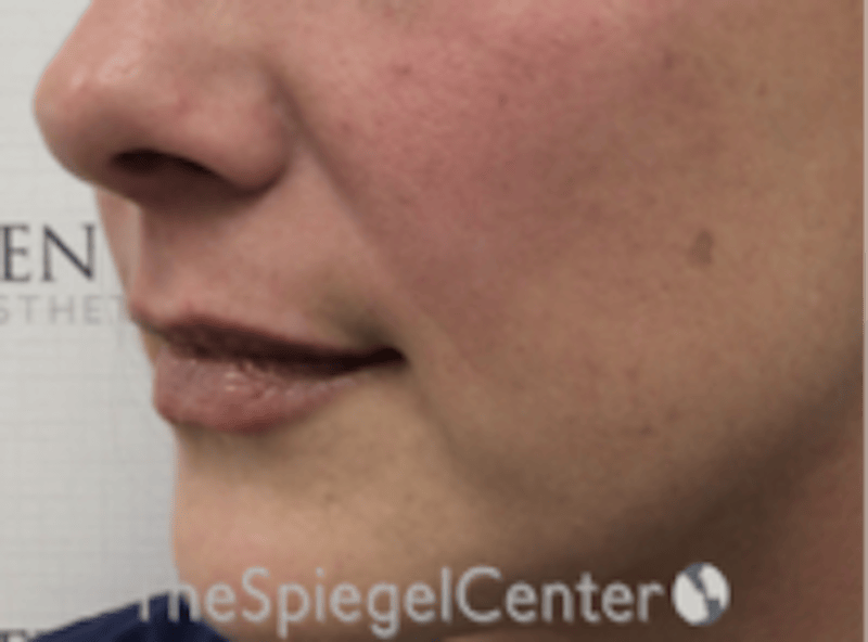 Lip Filler Before & After Gallery - Patient 618605 - Image 6