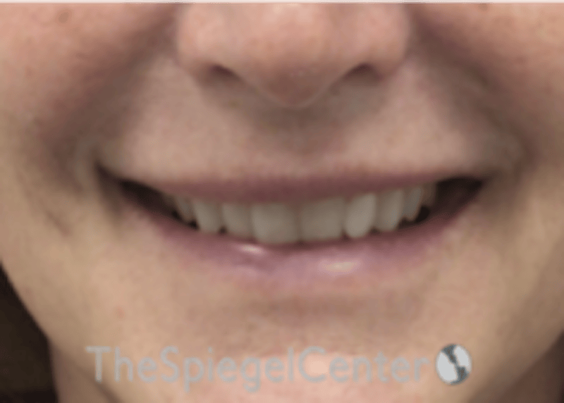 Lip Filler Before & After Gallery - Patient 124221 - Image 1