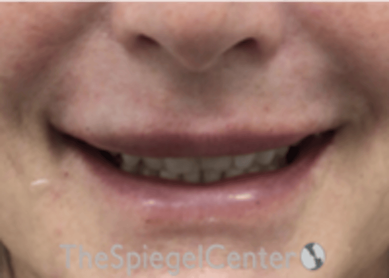Lip Filler Before & After Gallery - Patient 124221 - Image 2