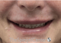 Lip Filler Before & After Gallery - Patient 124221 - Image 2