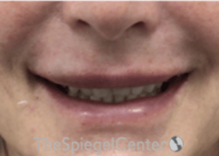 Lip Filler Before & After Gallery - Patient 124221 - Image 2