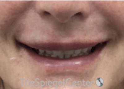 Lip Filler Before & After Gallery - Patient 124221 - Image 2