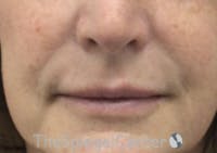 Lip Filler Before & After Gallery - Patient 124221 - Image 3