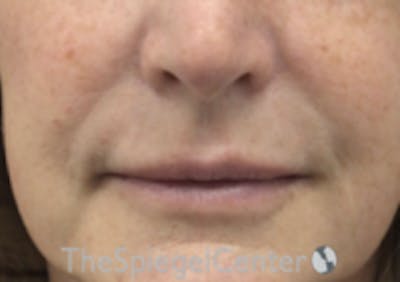 Lip Filler Before & After Gallery - Patient 124221 - Image 3
