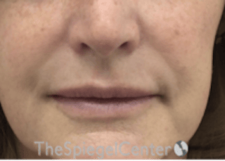 Lip Filler Before & After Gallery - Patient 124221 - Image 4