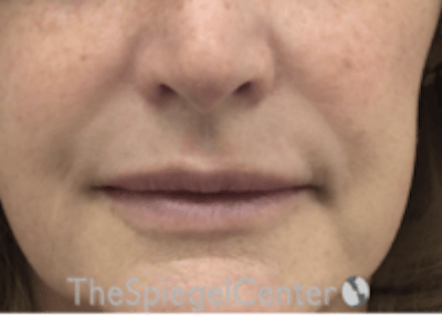 Lip Filler Before & After Gallery - Patient 124221 - Image 4