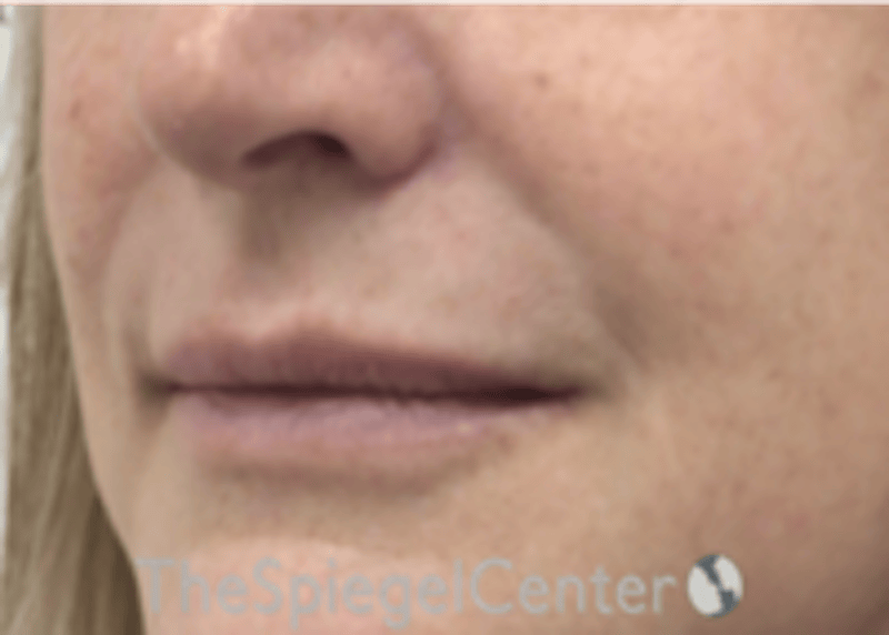 Lip Filler Before & After Gallery - Patient 124221 - Image 5