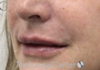 Lip Filler Before & After Gallery - Patient 124221 - Image 6