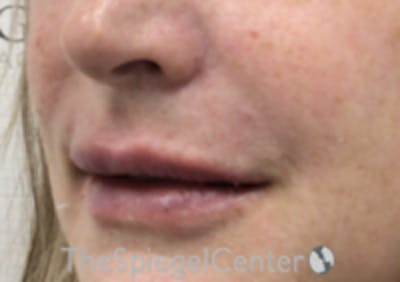 Lip Filler Before & After Gallery - Patient 124221 - Image 6