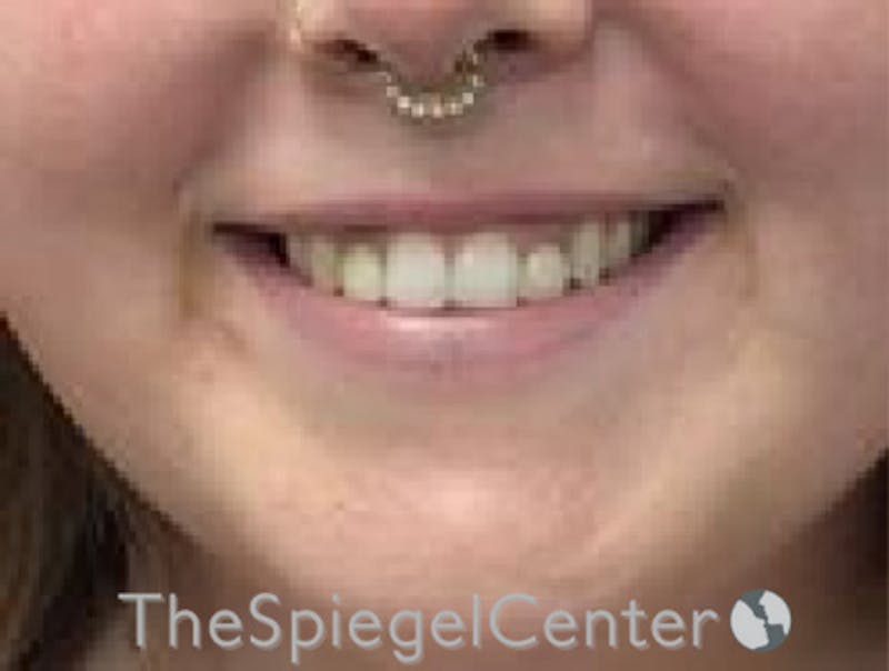 Lip Filler Before & After Gallery - Patient 280138 - Image 1