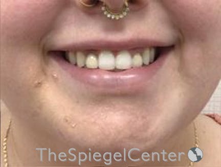 Lip Filler Before & After Gallery - Patient 280138 - Image 2