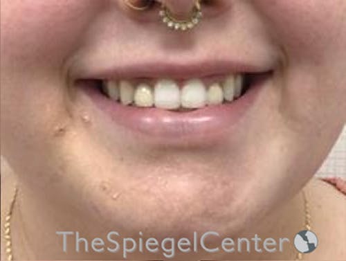 Lip Filler Before & After Gallery - Patient 280138 - Image 2