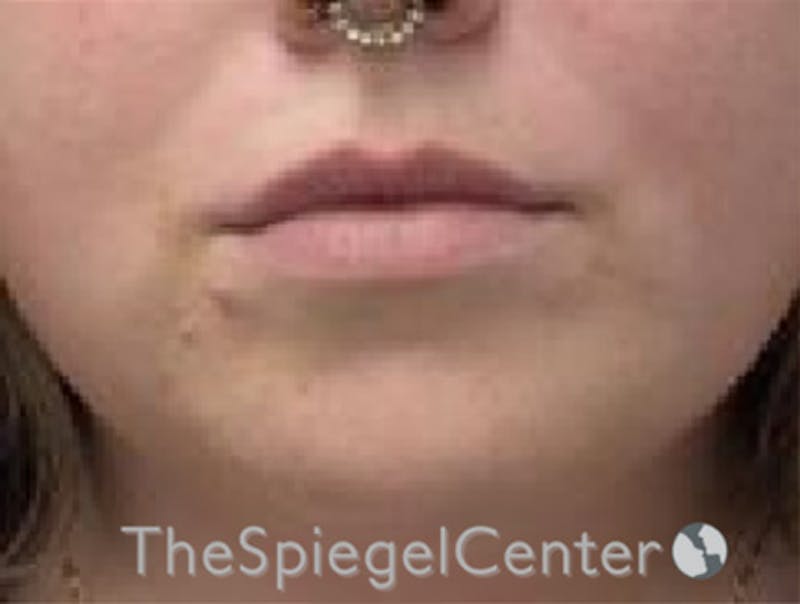 Lip Filler Before & After Gallery - Patient 280138 - Image 3