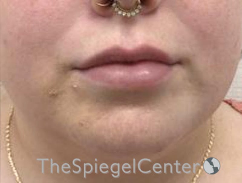 Lip Filler Before & After Gallery - Patient 280138 - Image 4