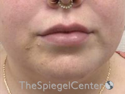 Lip Filler Before & After Gallery - Patient 280138 - Image 4