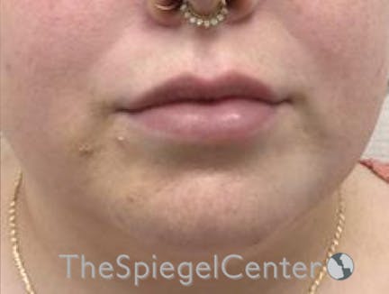 Lip Filler Before & After Gallery - Patient 280138 - Image 4