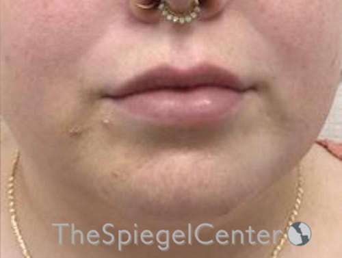 Lip Filler Before & After Gallery - Patient 280138 - Image 4