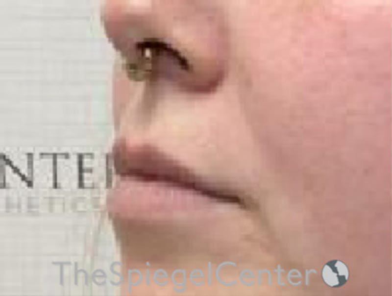 Lip Filler Before & After Gallery - Patient 280138 - Image 5