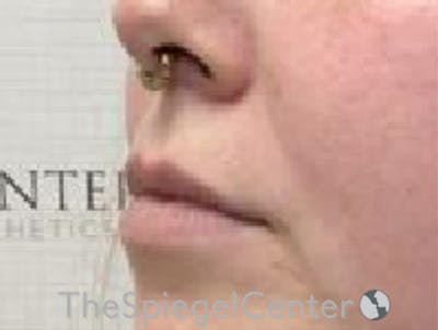 Lip Filler Before & After Gallery - Patient 280138 - Image 5