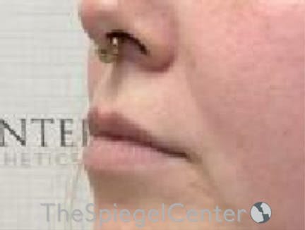 Lip Filler Before & After Gallery - Patient 280138 - Image 5