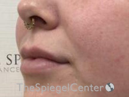 Lip Filler Before & After Gallery - Patient 280138 - Image 6