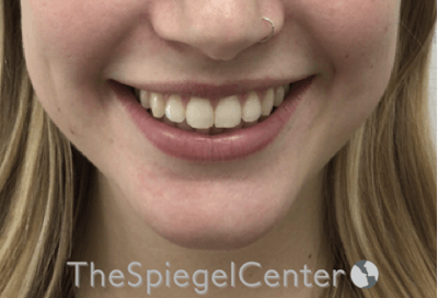 Lip Filler Before & After Gallery - Patient 108297 - Image 1