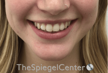 Lip Filler Before & After Gallery - Patient 108297 - Image 1