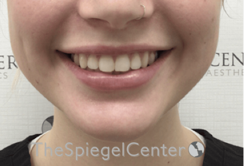 Lip Filler Before & After Gallery - Patient 108297 - Image 2