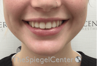 Lip Filler Before & After Gallery - Patient 108297 - Image 2