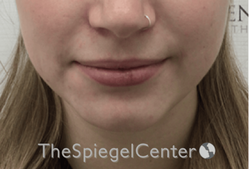 Lip Filler Before & After Gallery - Patient 108297 - Image 3