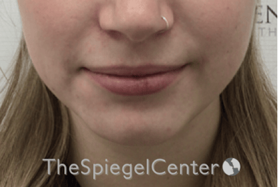 Lip Filler Before & After Gallery - Patient 108297 - Image 3