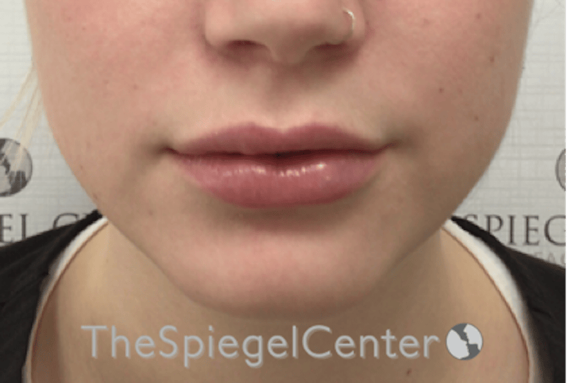 Lip Filler Before & After Gallery - Patient 108297 - Image 4