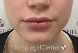 Lip Filler Before & After Gallery - Patient 108297 - Image 4