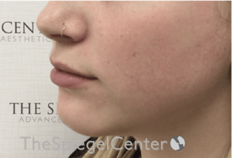 Lip Filler Before & After Gallery - Patient 108297 - Image 5